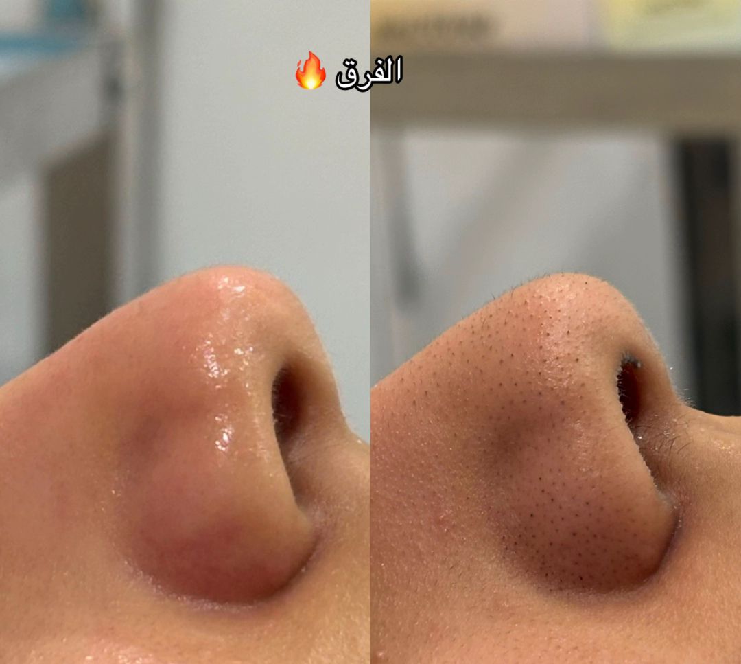 نتيجة قبل وبعد 1