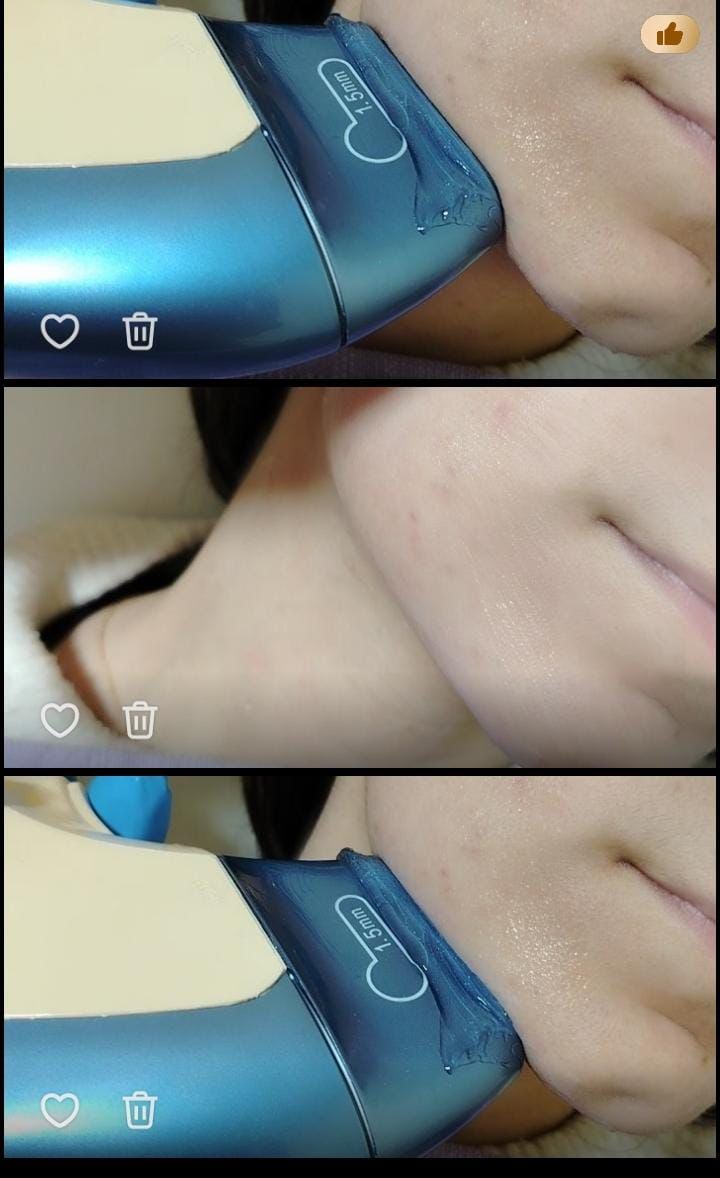 نتيجة قبل وبعد 2